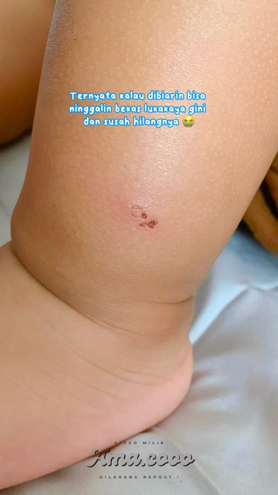 Buibu wajib cobain #RacunShopee #hibooallpourpoosebabybalm #hiboobabybalm #bekasgigitannyamuk #bekasluka #skincareanak